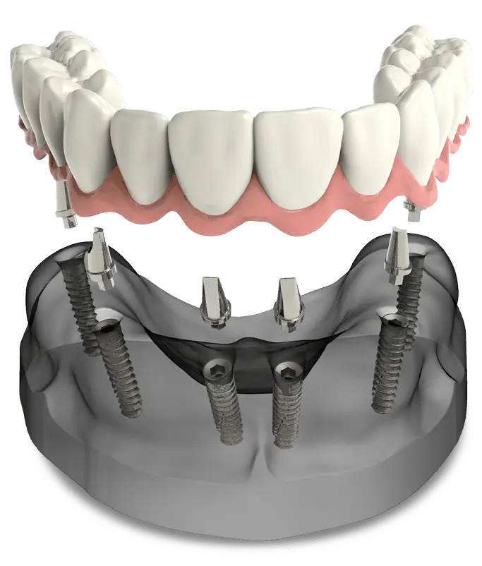 full-mouth-dental-implant-banner